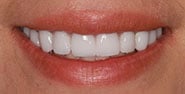 After Image: Case 366 - front