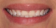 Before Image: Case 366 - front
