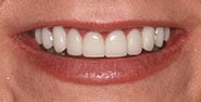After Image: Case 367 - front