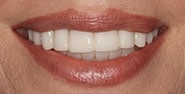 After Image: Case 368 - front