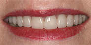 After Image: Case 37 - front