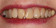 Before Image: Case 37 - front