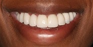 After Image: Case 370 - front