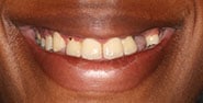 Before Image: Case 370 - front