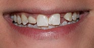 Before Image: Case 372 - front