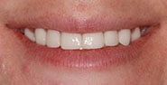 After Image: Case 374 - front