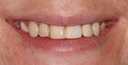 Before Image: Case 374 - front