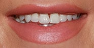 Before Image: Case 375 - front