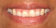 Before Image: Case 376 - front