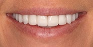 After Image: Case 377 - front