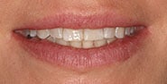 Before Image: Case 377 - front