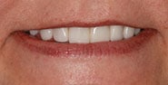 After Image: Case 378 - front