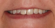 Before Image: Case 378 - front