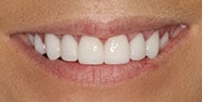 After Image: Case 379 - front