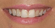 Before Image: Case 379 - front