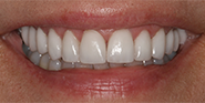 After Image: Case 38 - front