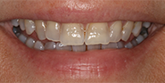 Before Image: Case 38 - front