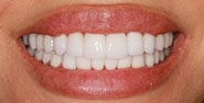 After Image: Case 380 - front