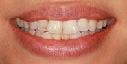 Before Image: Case 380 - front