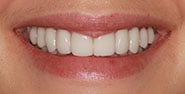 After Image: Case 381 - front