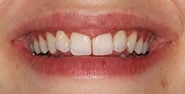 Before Image: Case 381 - front