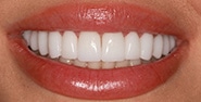 After Image: Case 382 - front