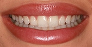 Before Image: Case 382 - front