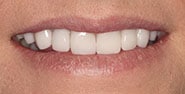 After Image: Case 383 - front