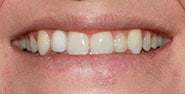 Before Image: Case 383 - front