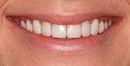 After Image: Case 384 - front