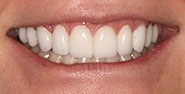 After Image: Case 385 - front