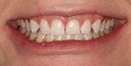 Before Image: Case 385 - front
