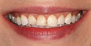 Before Image: Case 386 - front