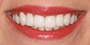 After Image: Case 387 - front