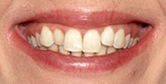Before Image: Case 387 - front