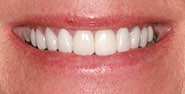 After Image: Case 388 - front