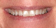 Before Image: Case 388 - front
