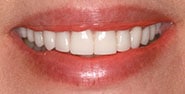 After Image: Case 389 - front