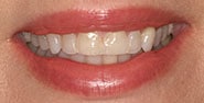 Before Image: Case 389 - front