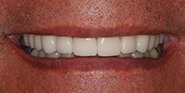 After Image: Case 39 - front