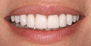 After Image: Case 390 - front