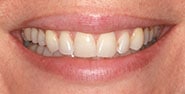Before Image: Case 390 - front
