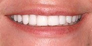 After Image: Case 391 - front