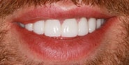 After Image: Case 392 - front