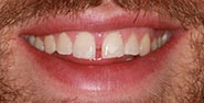 Before Image: Case 392 - front