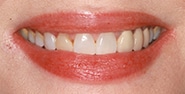 Before Image: Case 393 - front