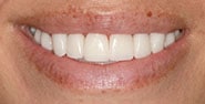 After Image: Case 394 - front