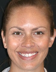 Before Image: Case 394 - front