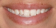 Before Image: Case 394 - front