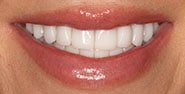 After Image: Case 395 - front